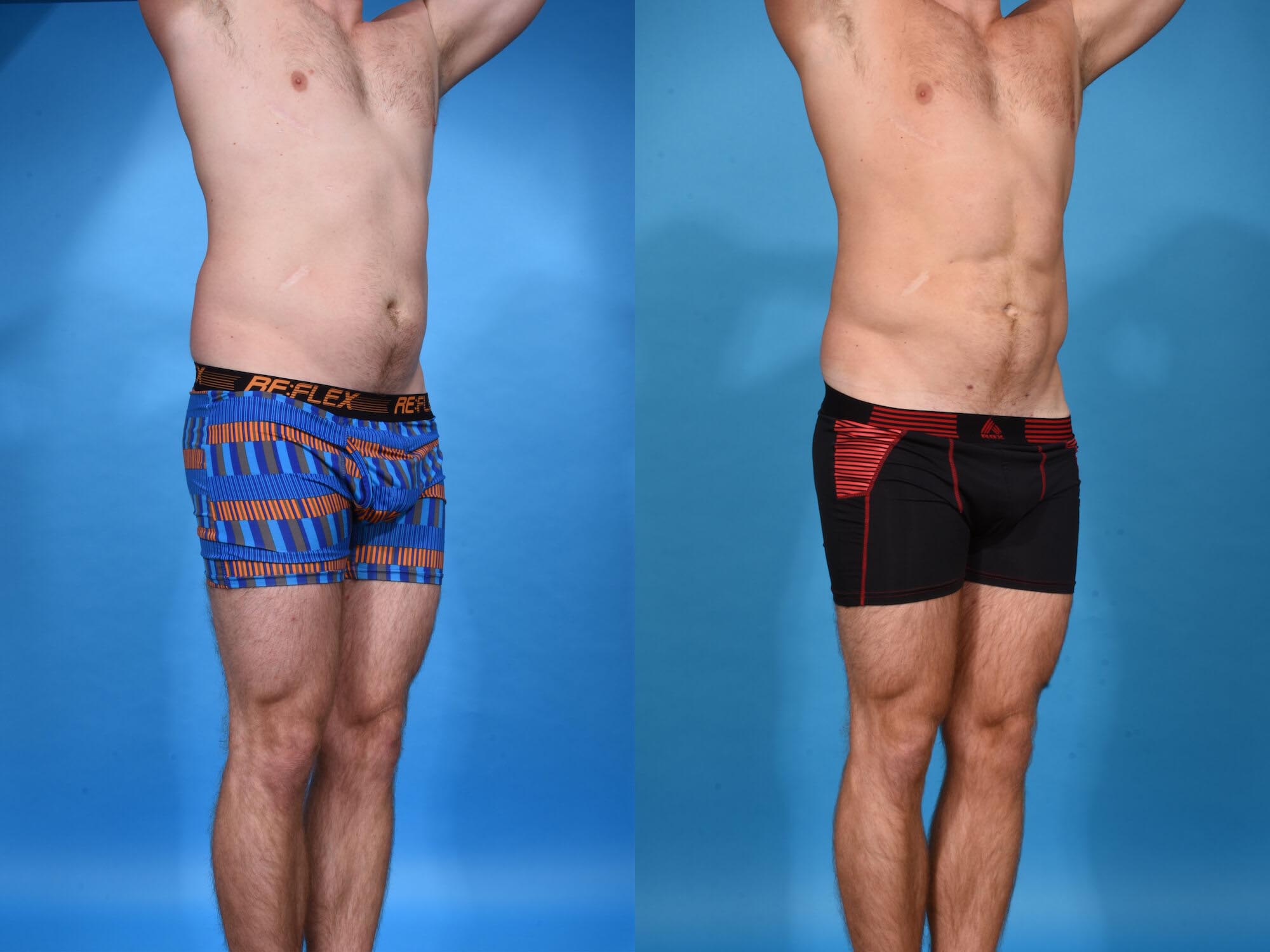 Abdominal Etching with High Definition Liposculpting Before and After Photo by Sculpt Aesthetic Center in Frisco, TX