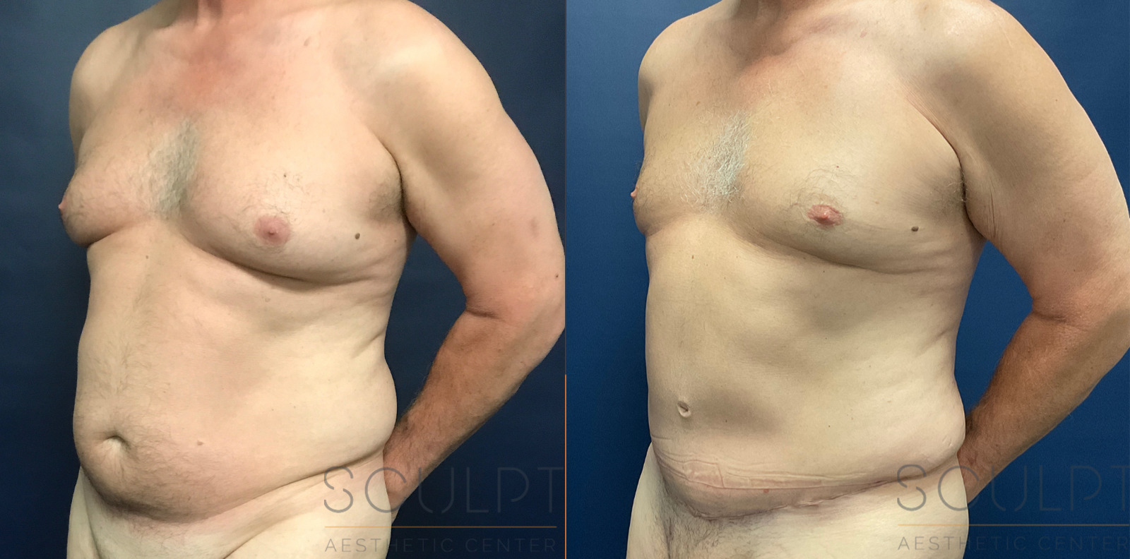 Liposuction to the Abdomen, Chest with Male Tummy Tuck Before and After Photo by Sculpt Aesthetic Center in Frisco, TX