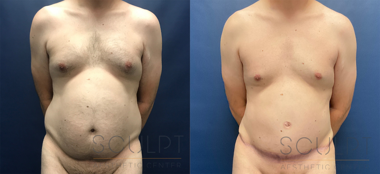 Male Tummy Tuck Before and After Photo by Sculpt Aesthetic Center in Frisco, TX