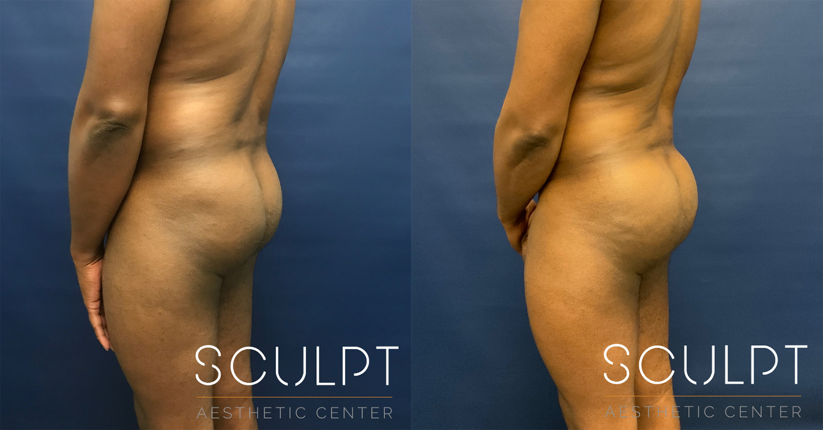 Male Gluteal (Buttock Augmentation) Before and After Photo by Sculpt Aesthetic Center in Frisco, TX