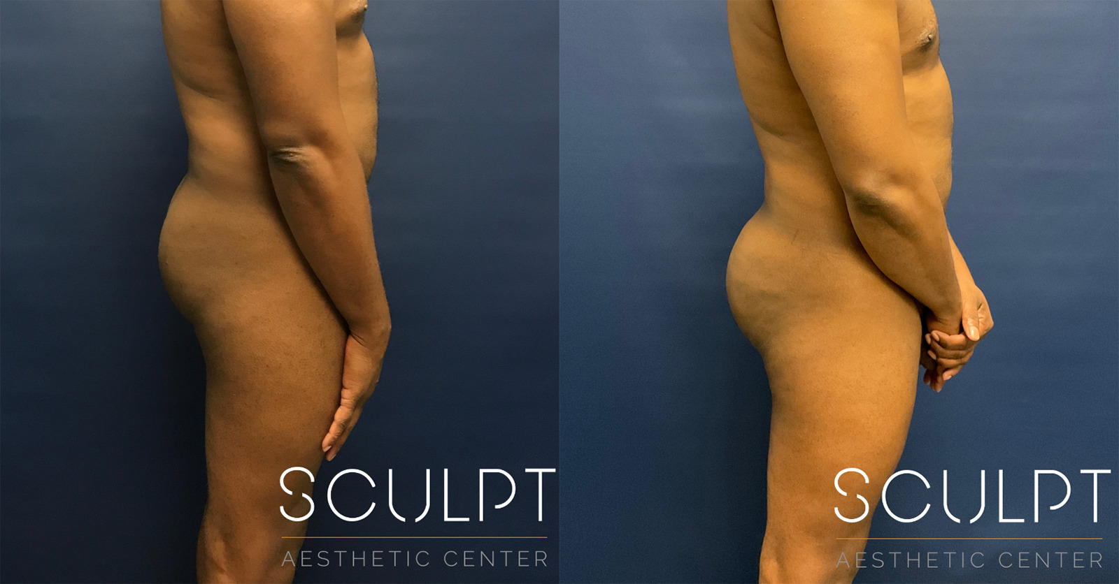Male Gluteal (Buttock Augmentation) Before and After Photo by Sculpt Aesthetic Center in Frisco, TX