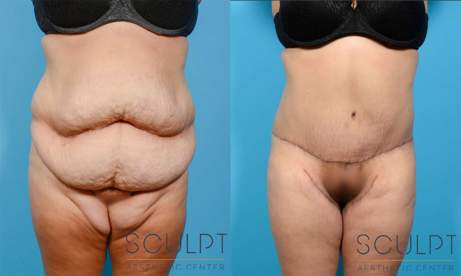 Female Thigh Lift Before and After Photo by Sculpt Aesthetic Center in Frisco, TX
