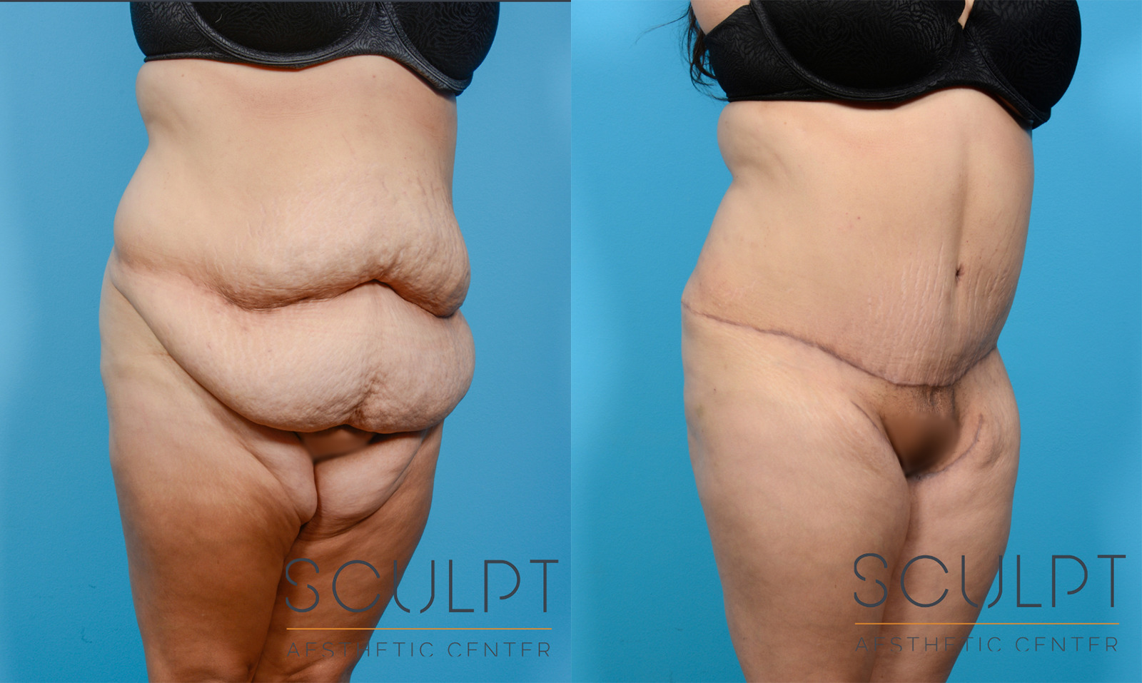 Female Tummy Tuck Before and After Photo by Sculpt Aesthetic Center in Frisco, TX