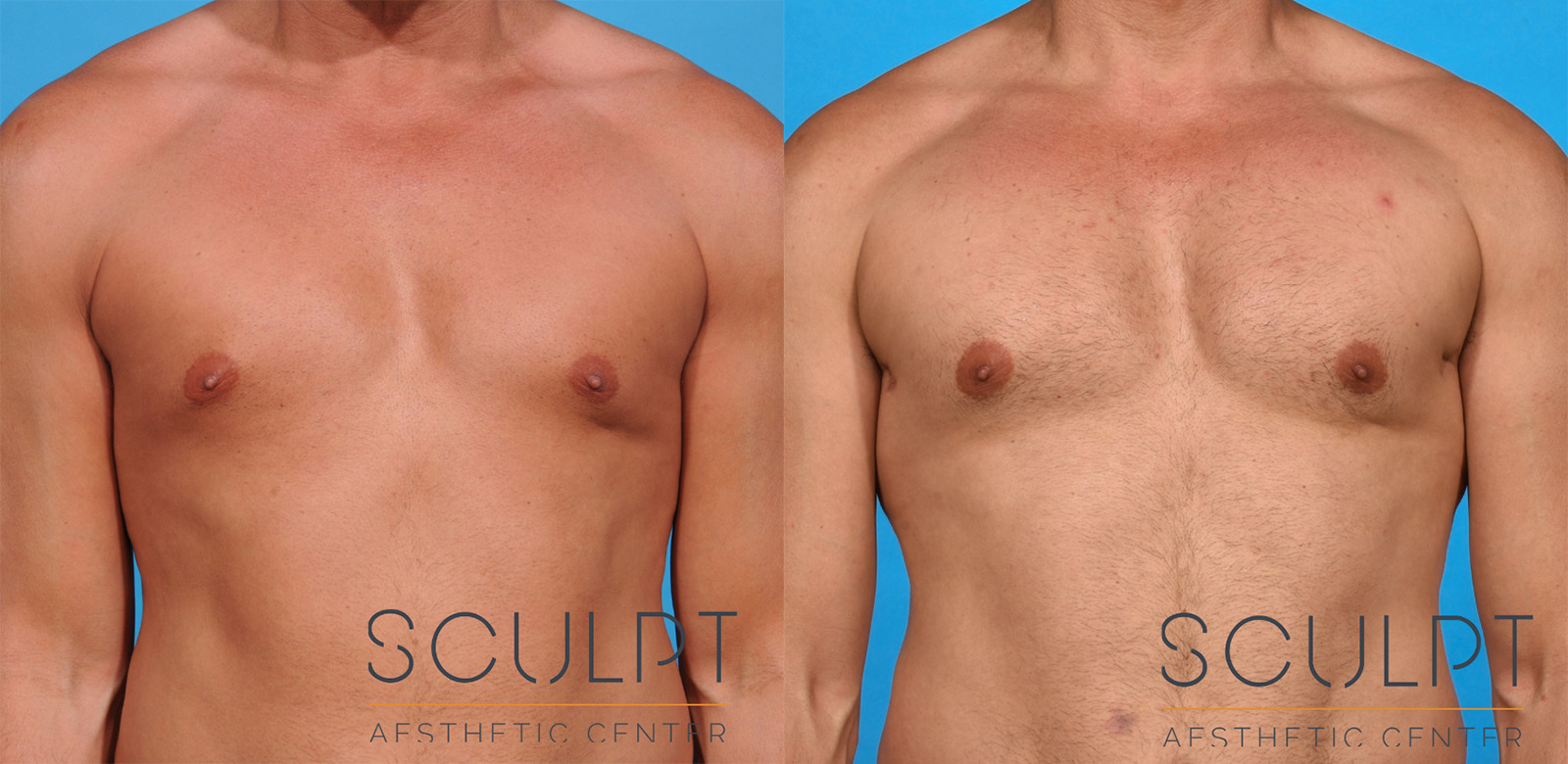 Male Pectoral Implants Before and After Photo by Sculpt Aesthetic Center in Frisco, TX