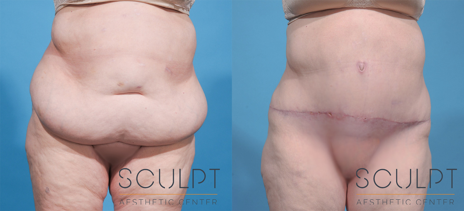 After Weight Loss Before and After Photo by Sculpt Aesthetic Center in Frisco, TX