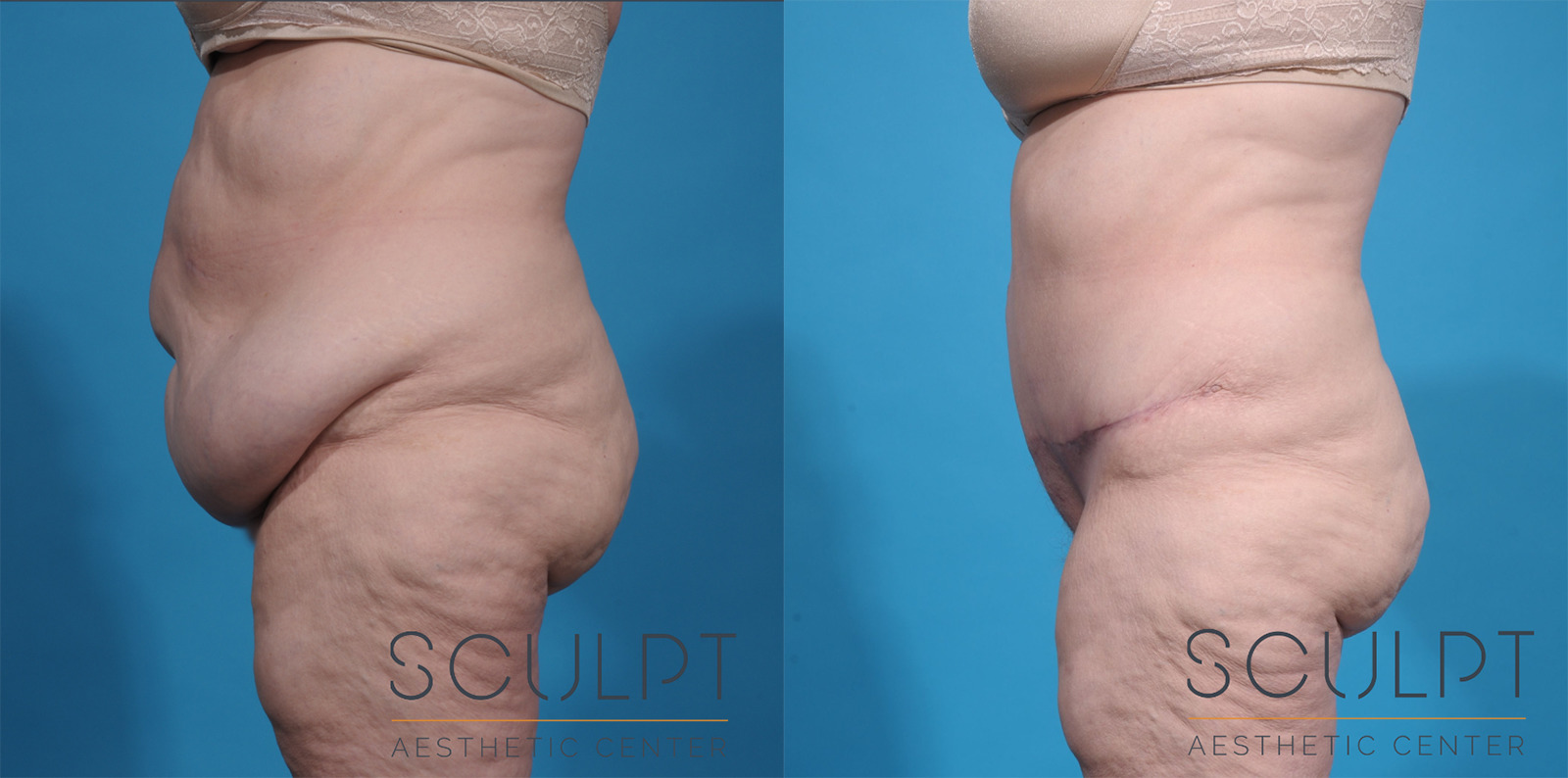 After Weight Loss Before and After Photo by Sculpt Aesthetic Center in Frisco, TX