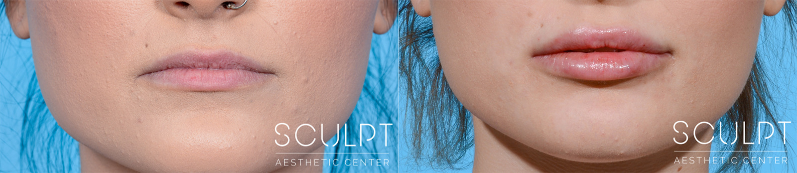 Facial Filler Before and After Photo by Sculpt Aesthetic Center in Frisco, TX