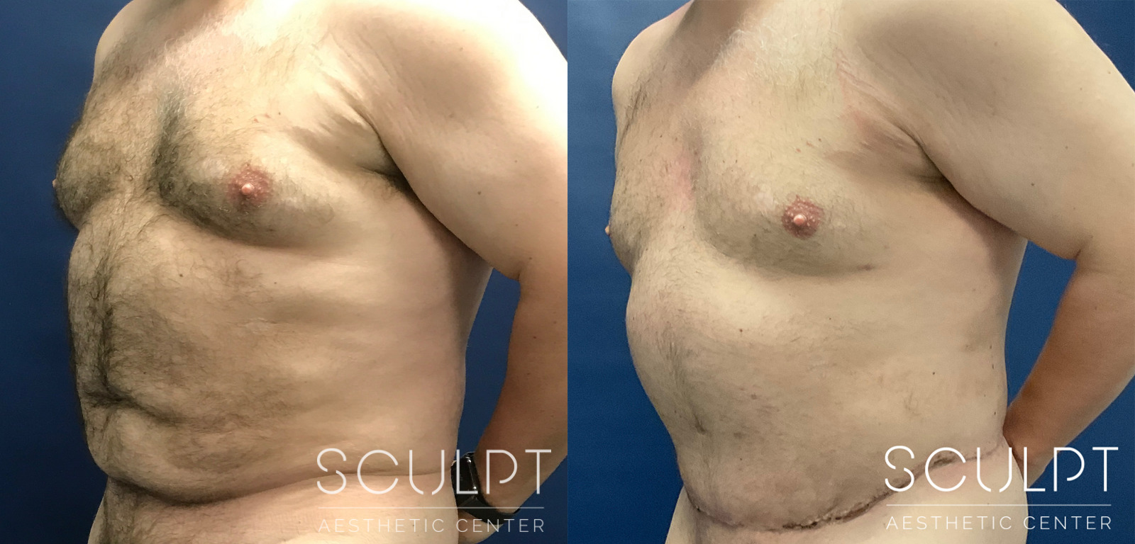 Male 360 Body LIft Before and After Photo by Sculpt Aesthetic Center in Frisco, TX