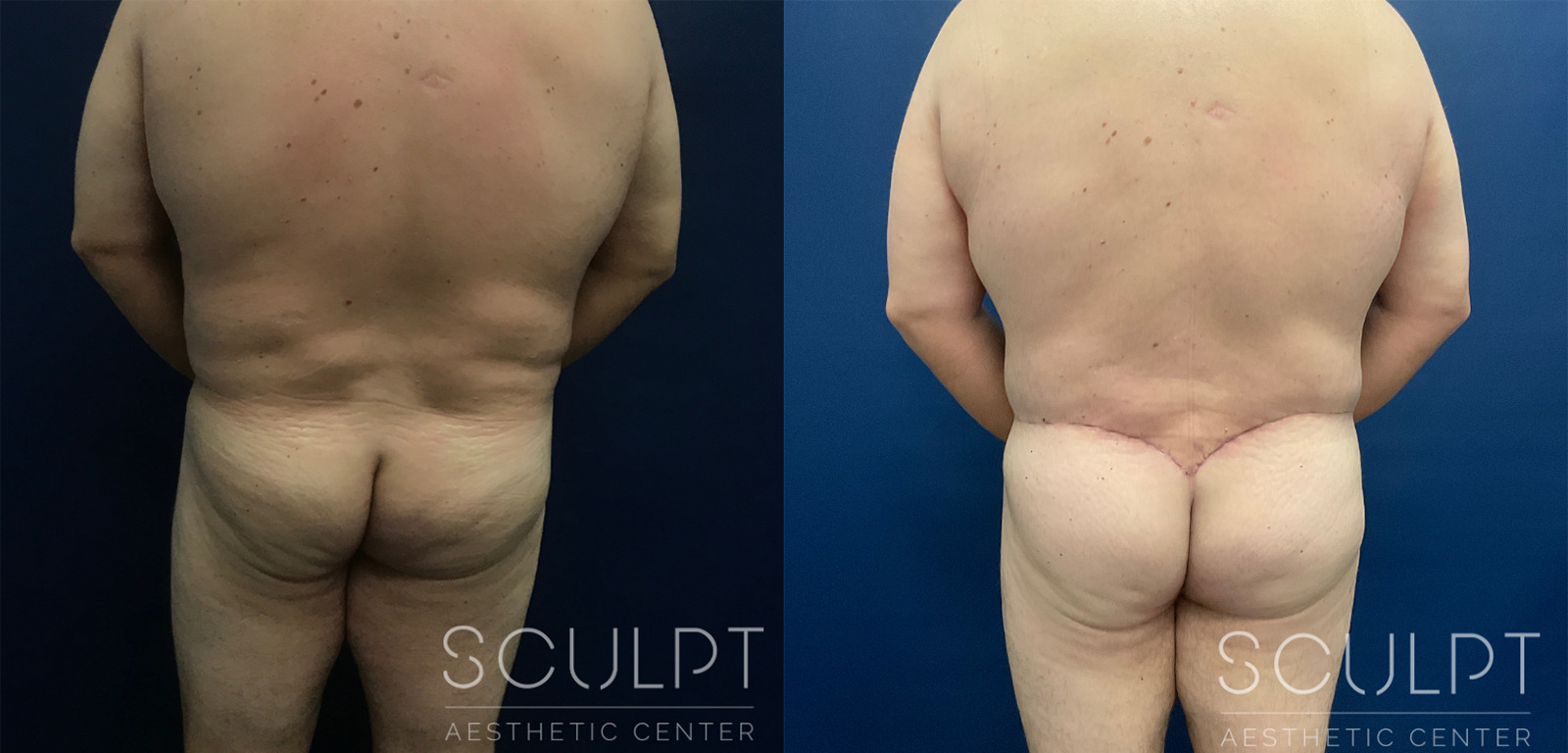 Male 360 Body LIft Before and After Photo by Sculpt Aesthetic Center in Frisco, TX