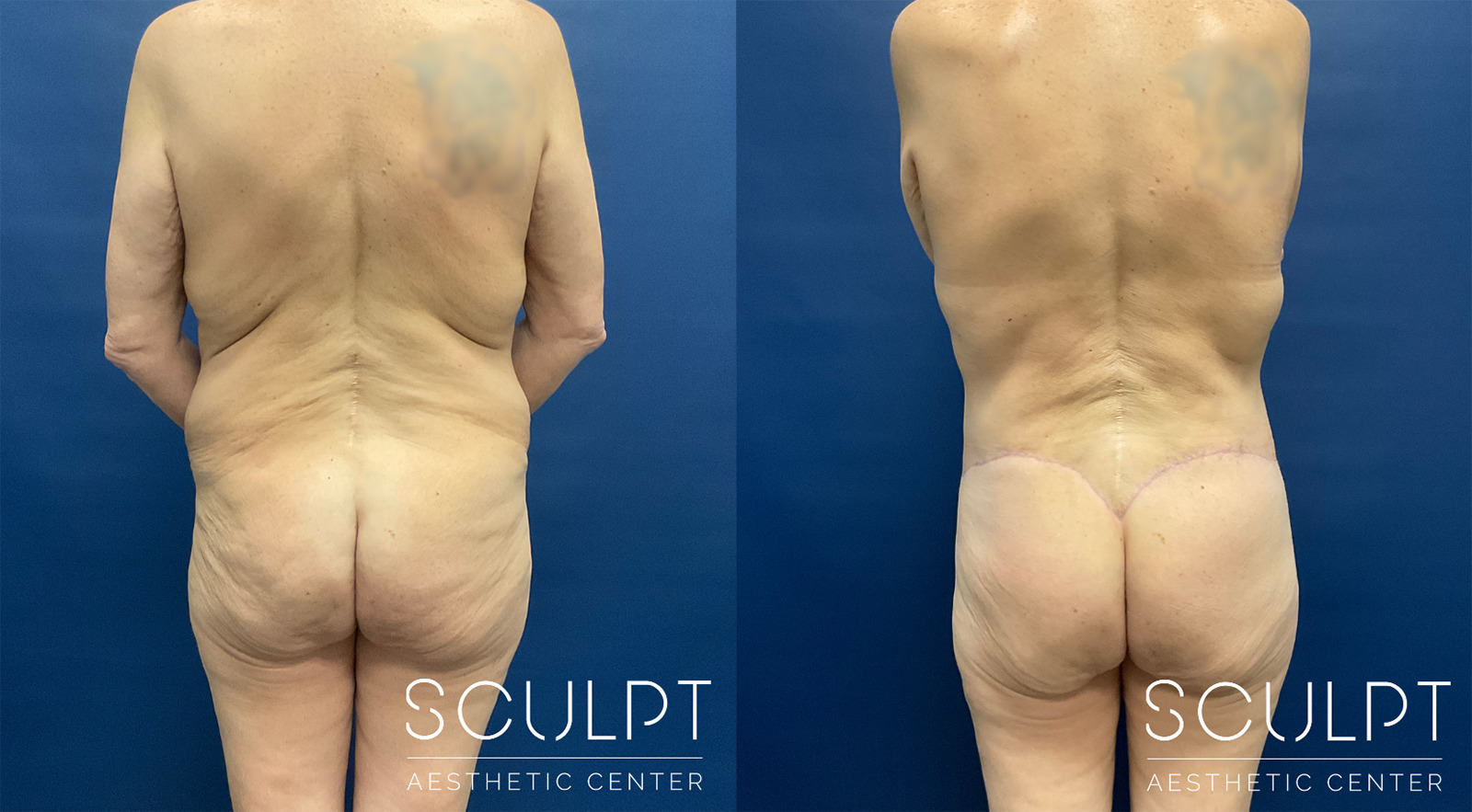 Female 360 Body Lift Before and After Photo by Sculpt Aesthetic Center in Frisco, TX