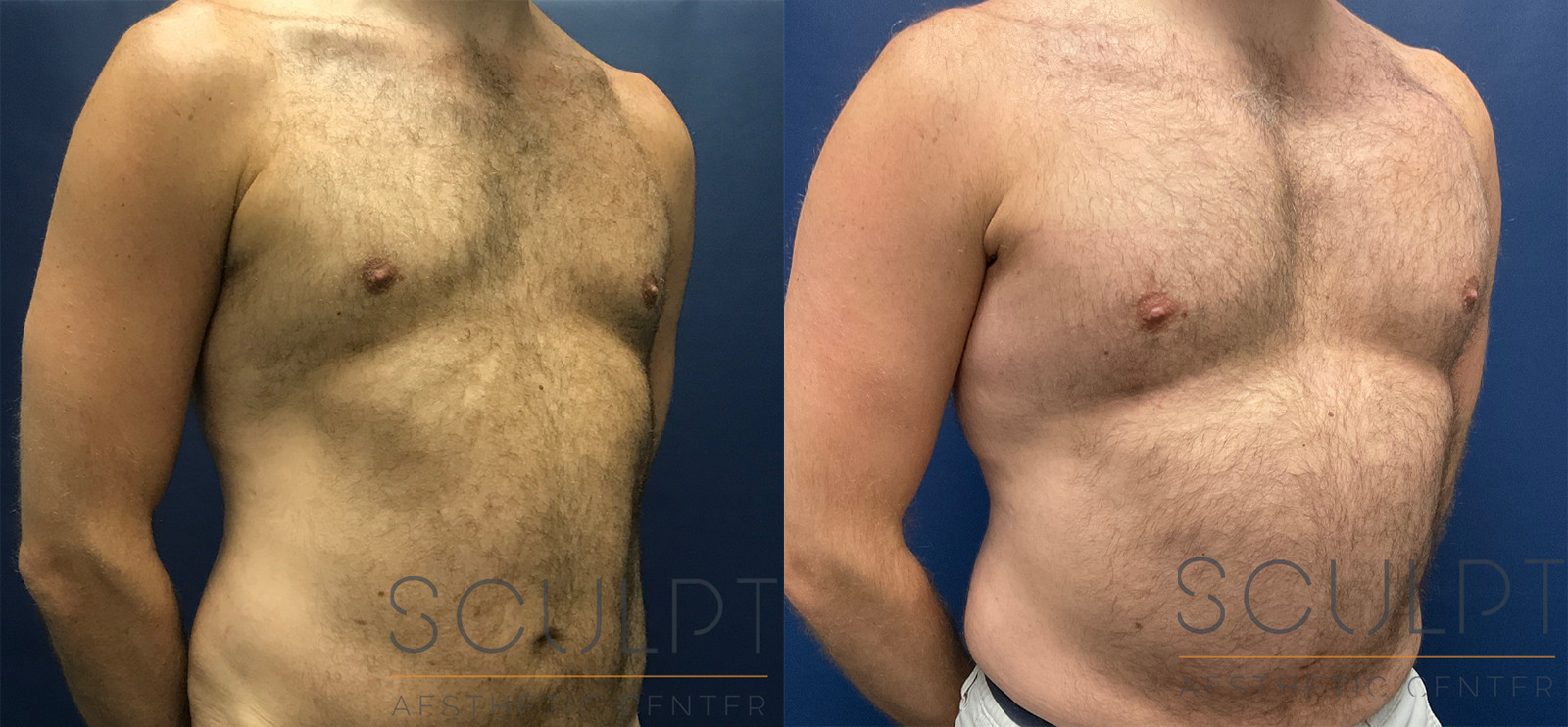 Male Pectoral Implants Before and After Photo by Sculpt Aesthetic Center in Frisco, TX