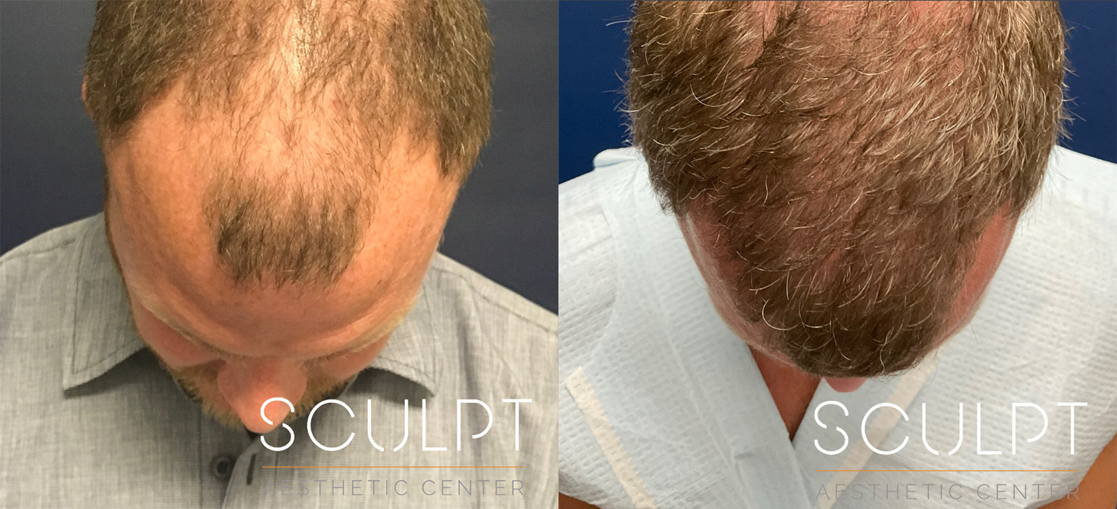 Male Hair Restoration Before and After Photo by Sculpt Aesthetic Center in Frisco, TX