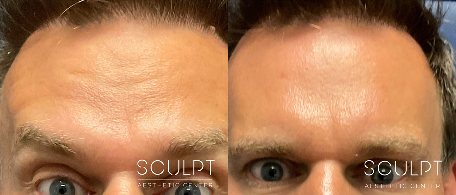 Botox/Dysport Before and After Photo by Sculpt Aesthetic Center in Frisco, TX