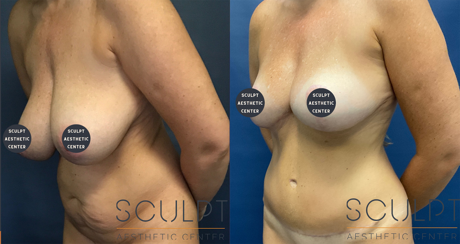 Mommy Makeover Before and After Photo by Sculpt Aesthetic Center in Frisco, TX