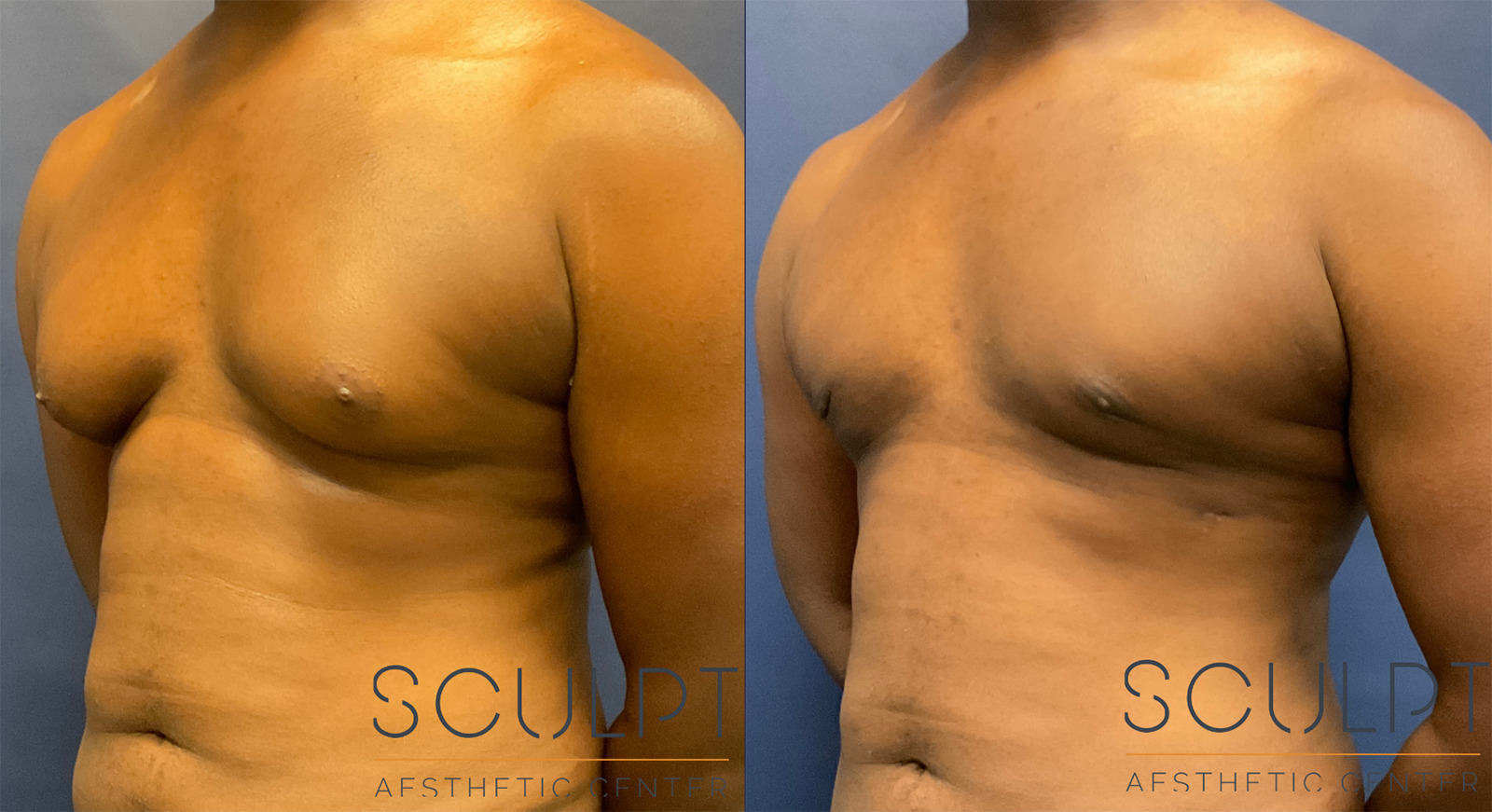 Gynecomastia Before and After Photo by Sculpt Aesthetic Center in Frisco, TX