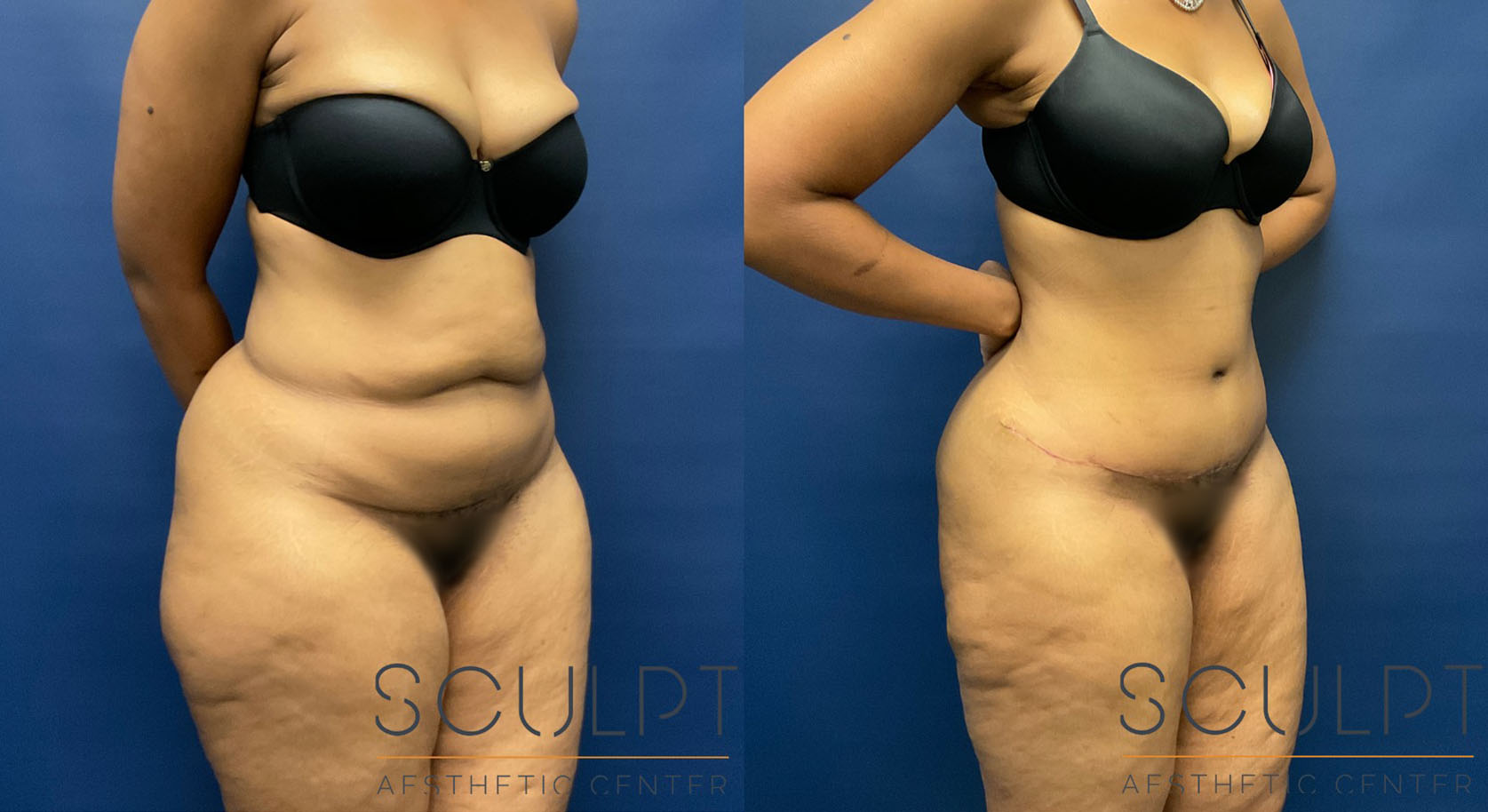 Tummy Tuck Before and After Photo by Sculpt Aesthetic Center in Frisco, TX