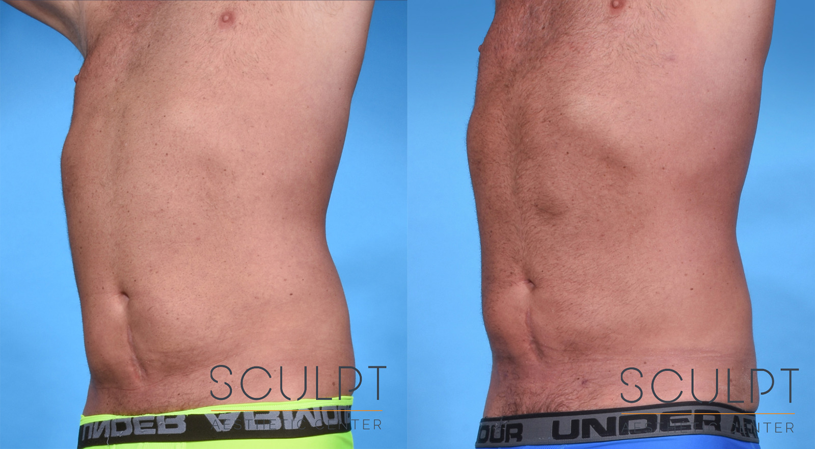 Male Abdominal Etching Before and After Photo by Sculpt Aesthetic Center in Frisco, TX