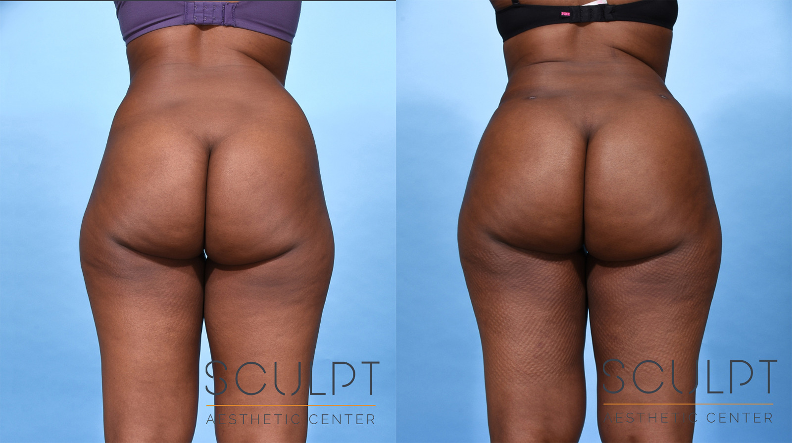 BBL(Brazilian Butt Lift) Before and After Photo by Sculpt Aesthetic Center in Frisco, TX