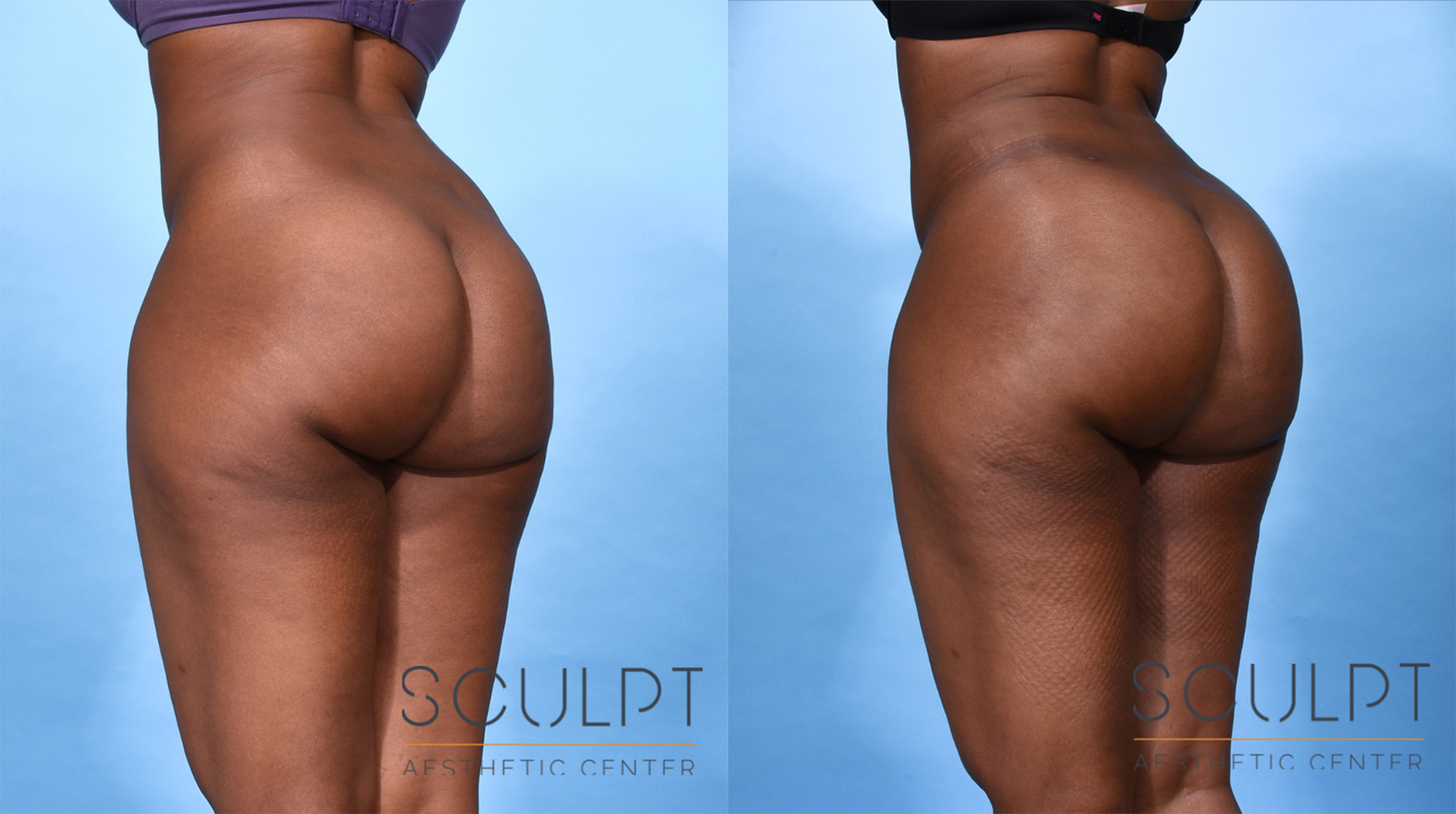 BBL(Brazilian Butt Lift) Before and After Photo by Sculpt Aesthetic Center in Frisco, TX
