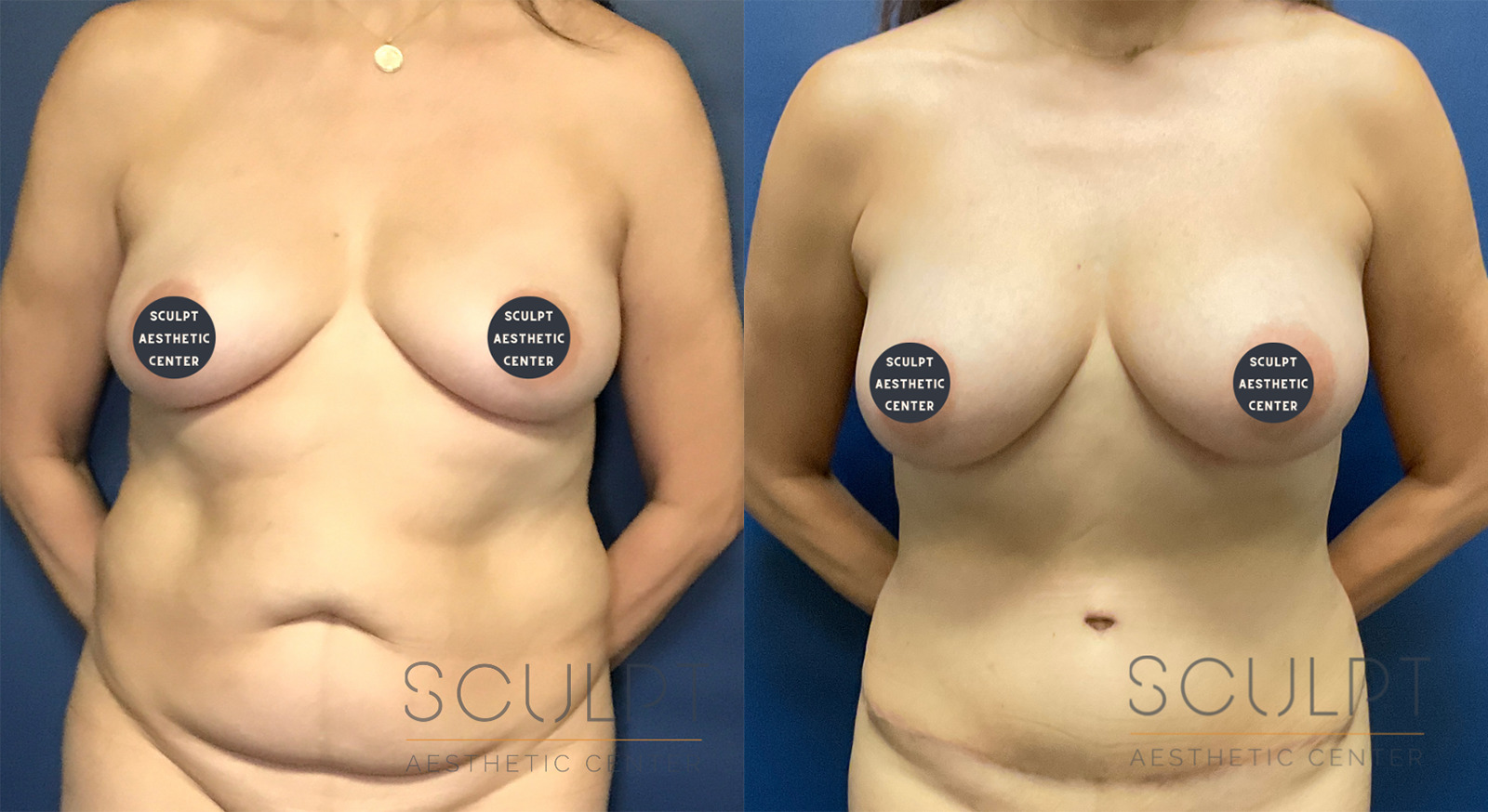 Female Tummy Tuck Before and After Photo by Sculpt Aesthetic Center in Frisco, TX