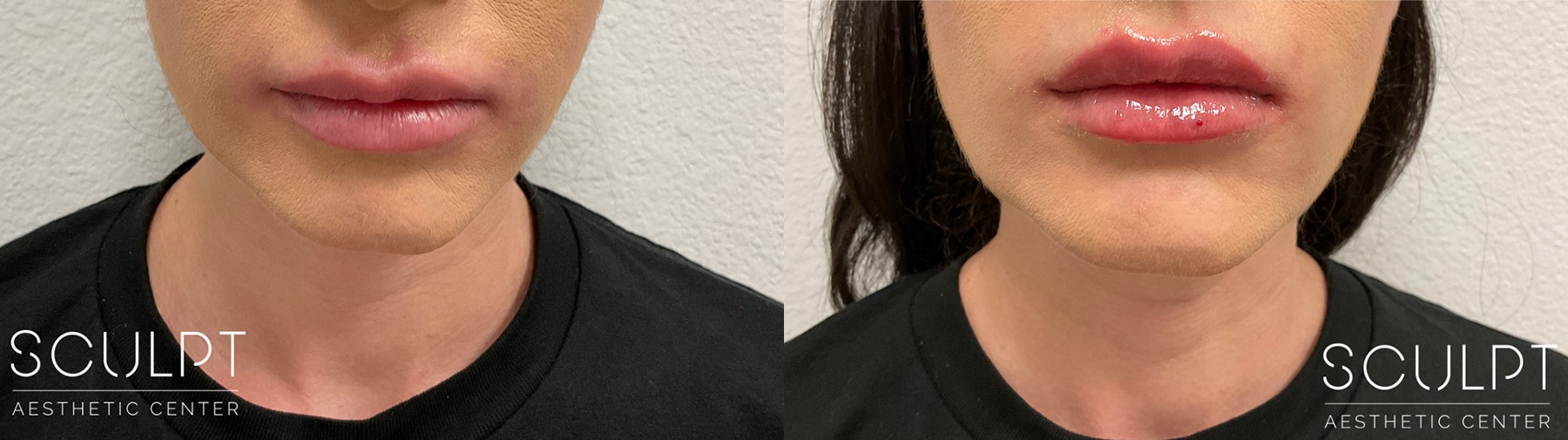 Lip Filler Before and After Photo by Sculpt Aesthetic Center in Frisco, TX