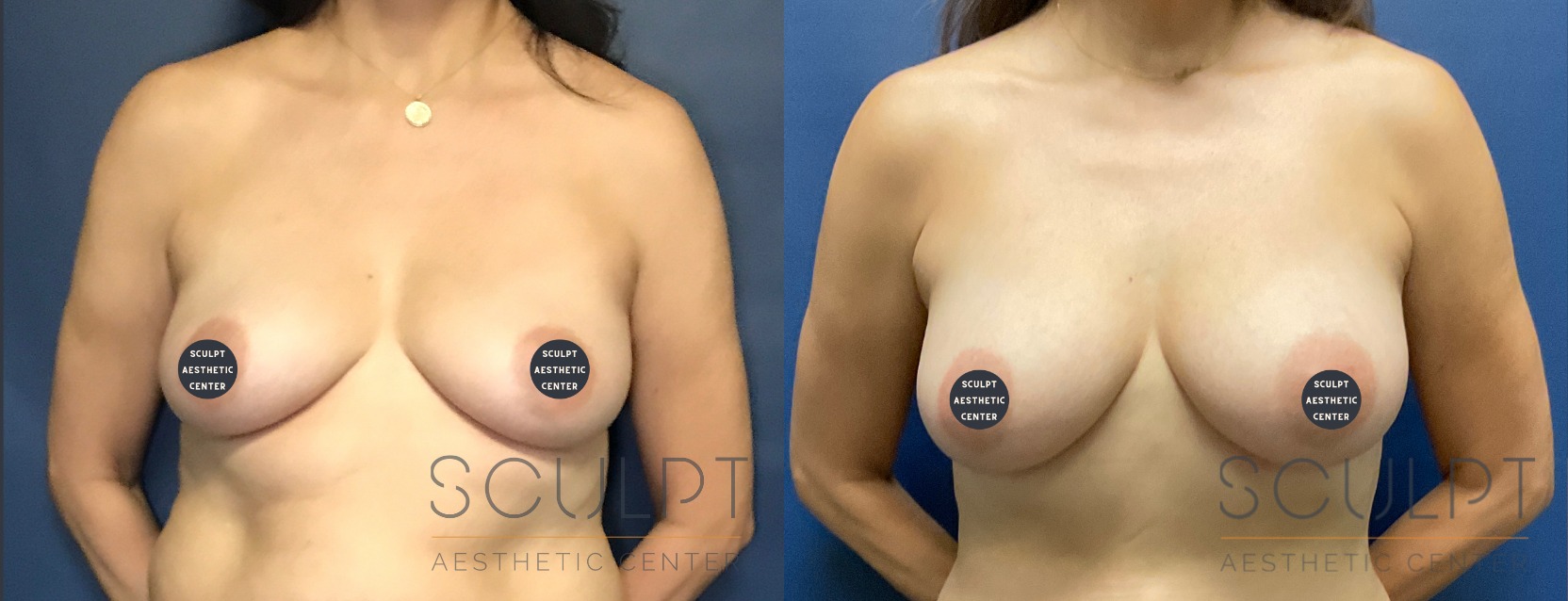 Breast Augmentation with Fat Before and After Photo by Sculpt Aesthetic Center in Frisco, TX