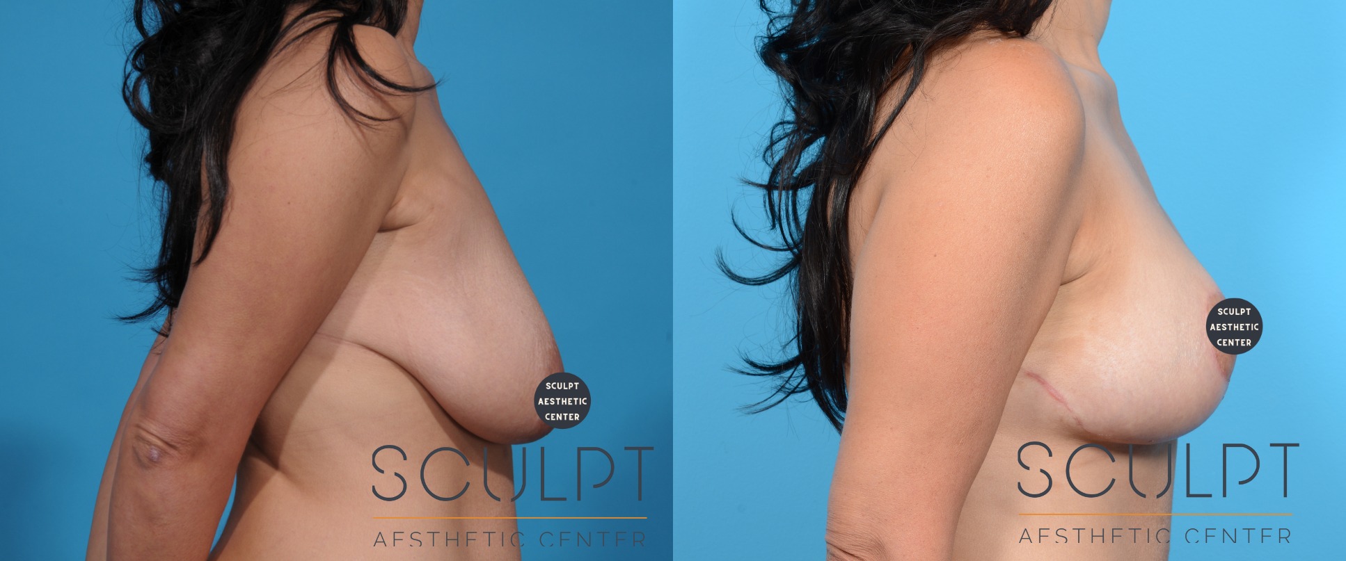 Breast Lift Before and After Photo by Sculpt Aesthetic Center in Frisco, TX