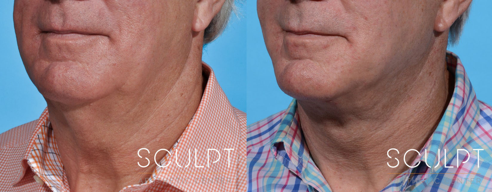 Face and Jawline Contouring Before and After Photo by Sculpt Aesthetic Center in Frisco, TX