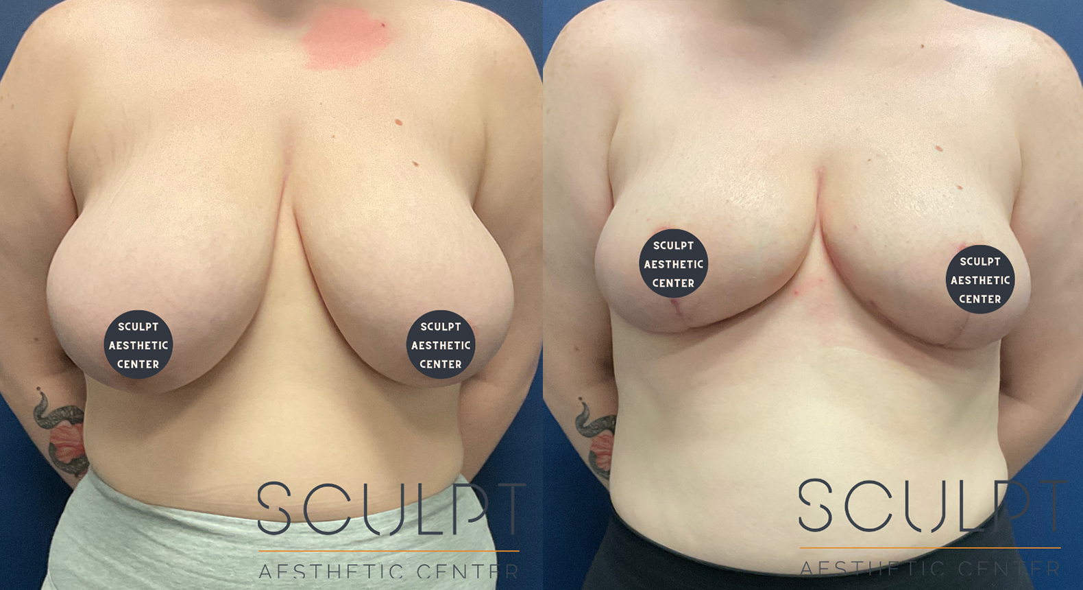 Breast Reduction Before and After Photo by Sculpt Aesthetic Center in Frisco, TX