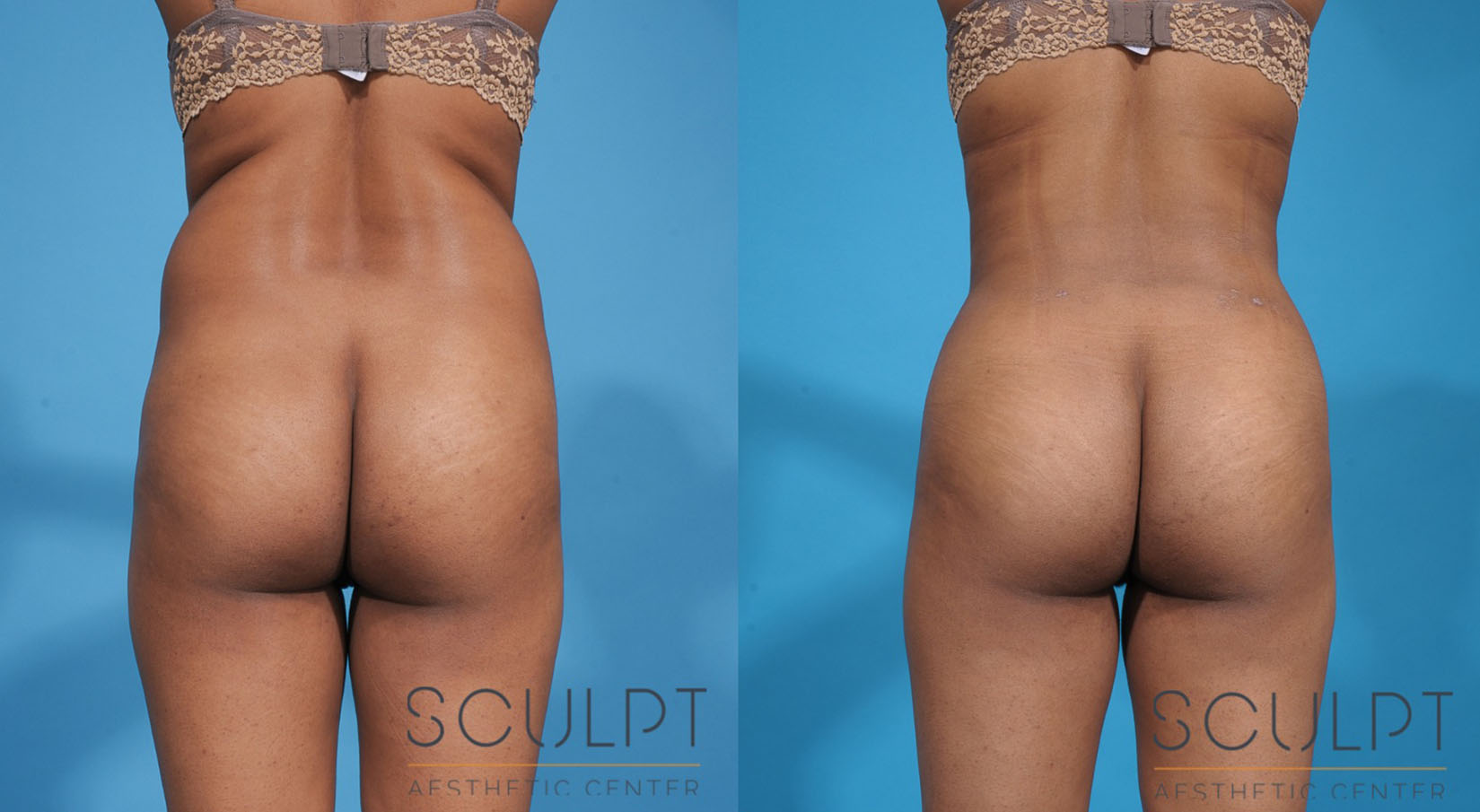 Liposuction Before and After Photo by Sculpt Aesthetic Center in Frisco, TX