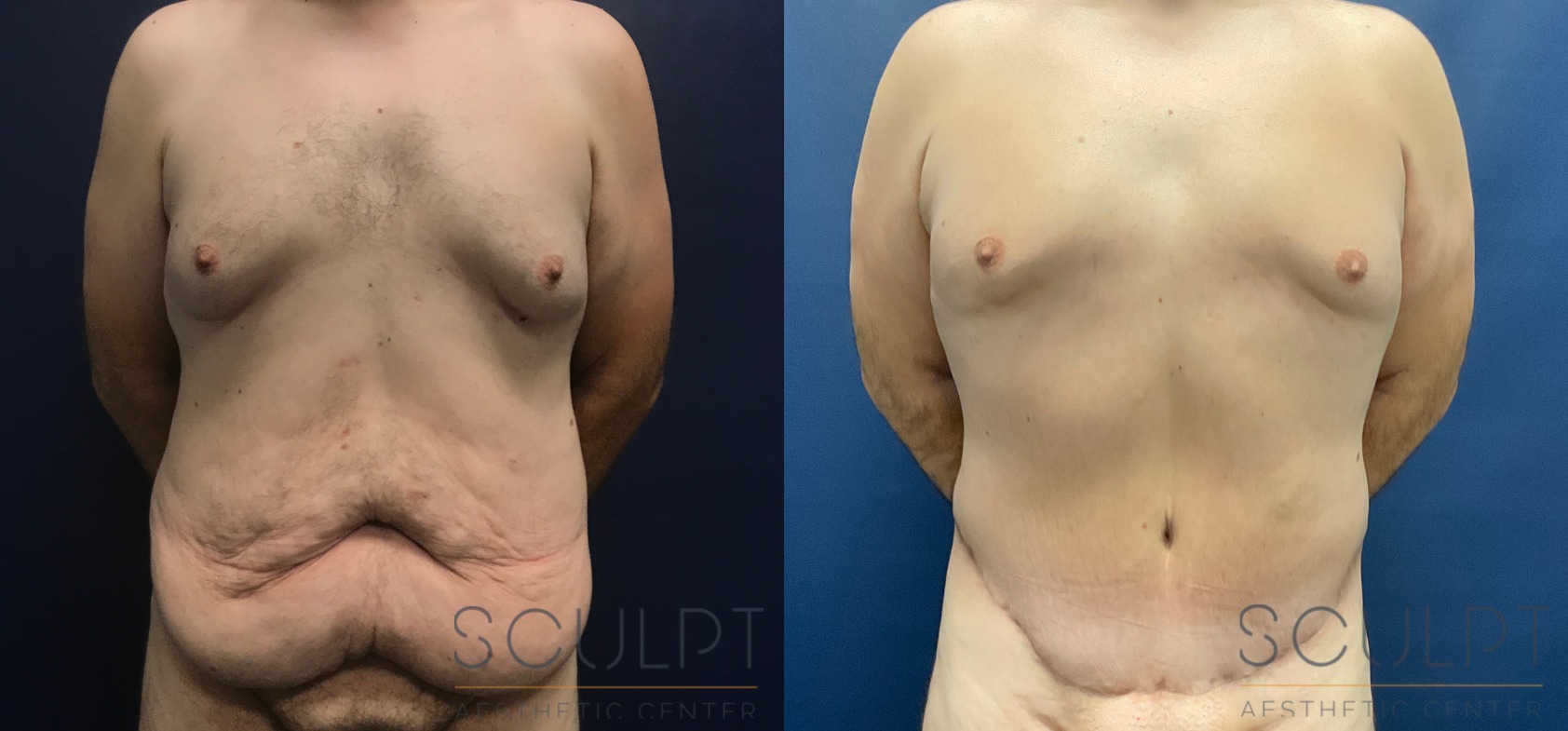 Male 360 Body Lift with Liposuction Before and After Photo by Sculpt Aesthetic Center in Frisco, TX