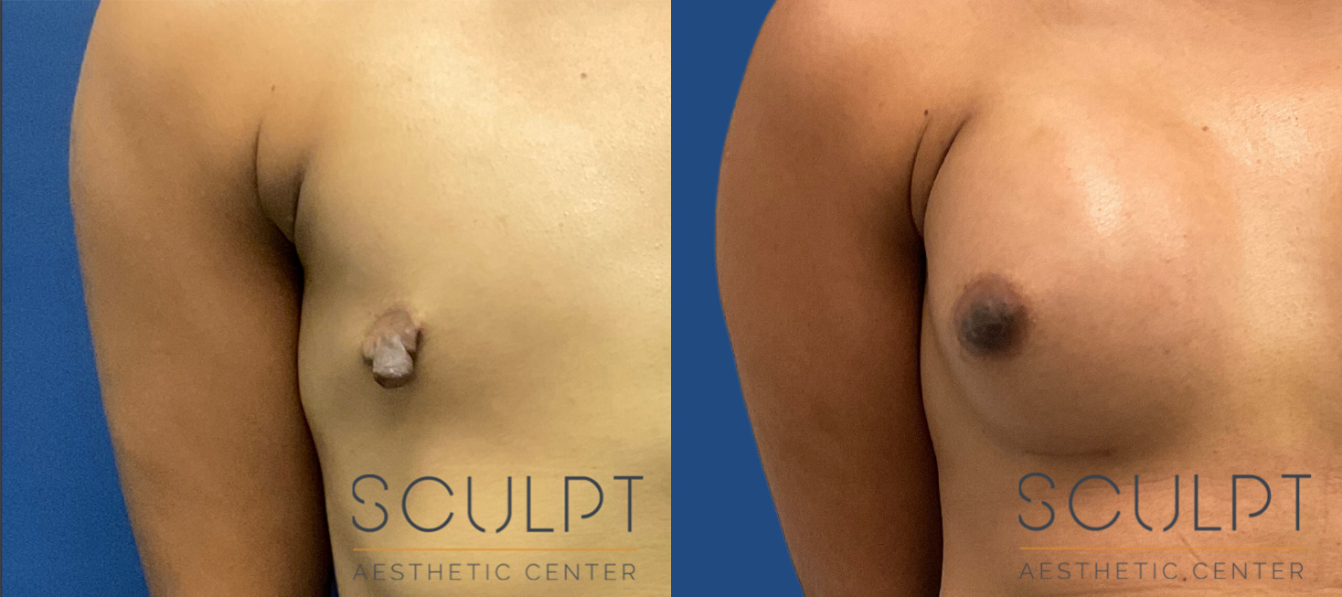 Female Nipple Reduction Before and After Photo by Sculpt Aesthetic Center in Frisco, TX