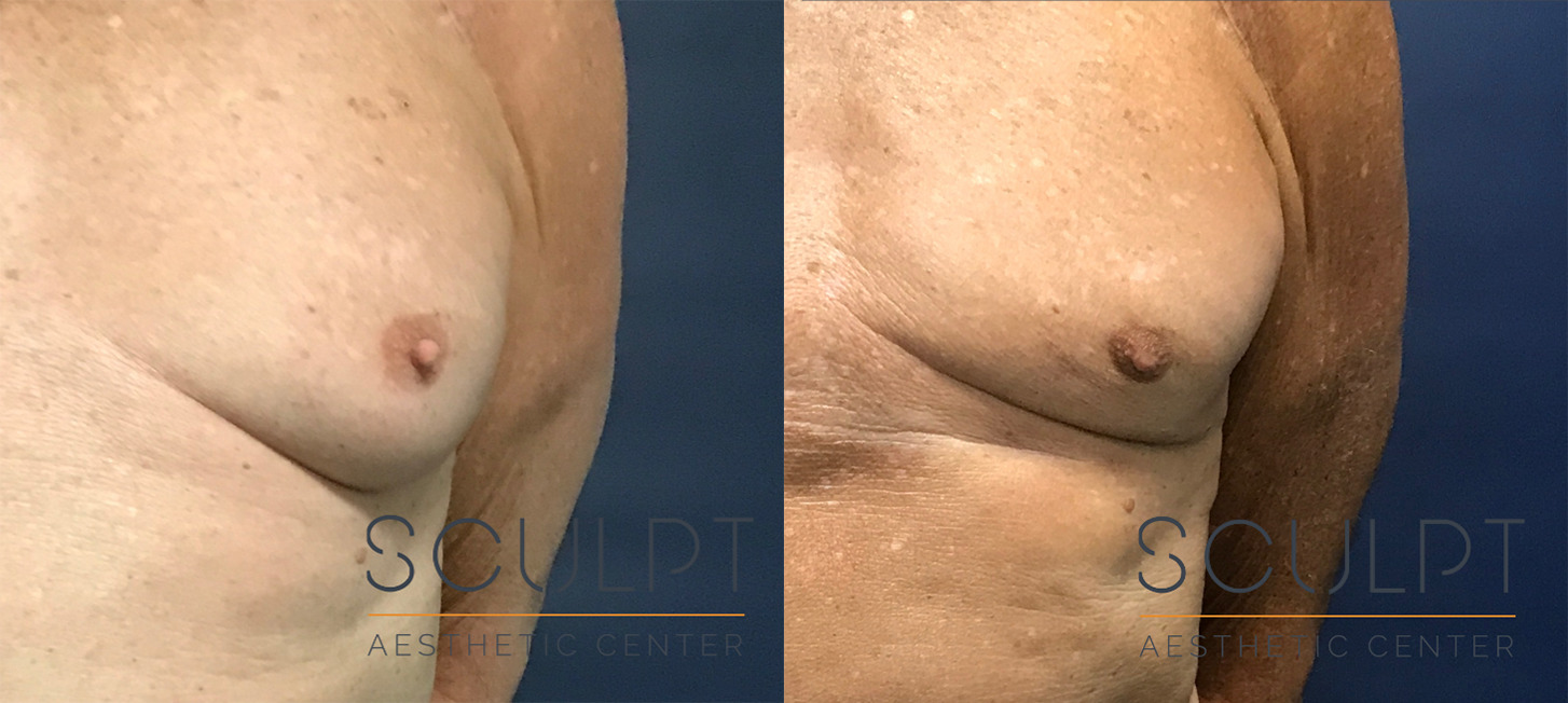 Male Nipple Reduction Before and After Photo by Sculpt Aesthetic Center in Frisco, TX