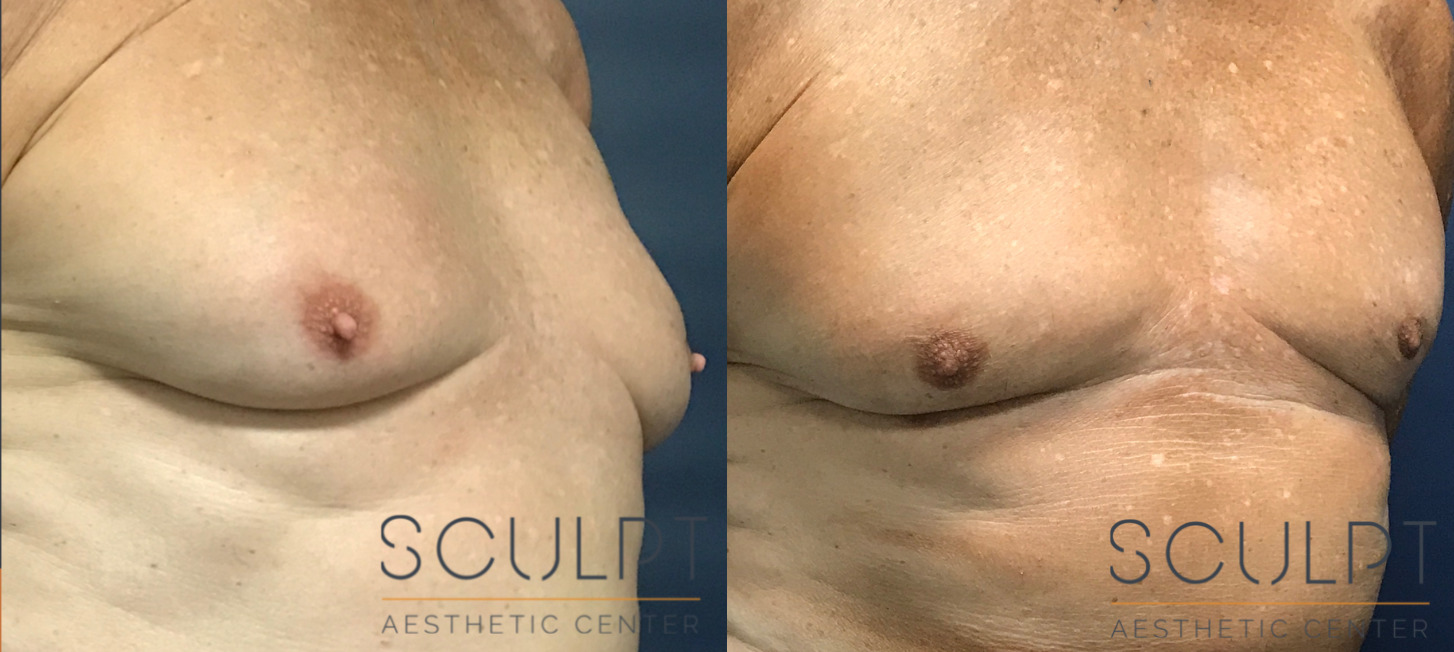Male Nipple Reduction Before and After Photo by Sculpt Aesthetic Center in Frisco, TX