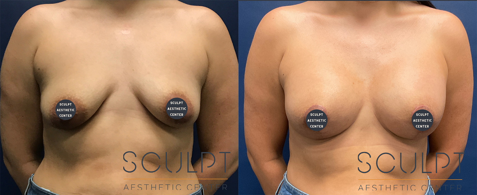 Breast Lift Before and After Photo by Sculpt Aesthetic Center in Frisco, TX