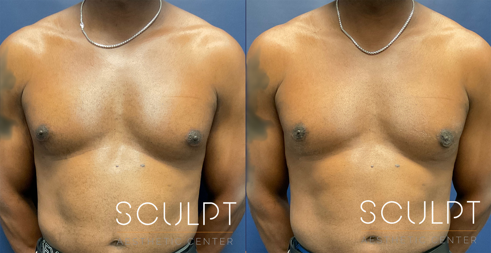 Gynecomastia Before and After Photo by Sculpt Aesthetic Center in Frisco, TX