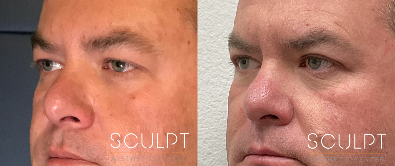 Male Eyelid Surgery Before and After Photo by Sculpt Aesthetic Center in Frisco, TX