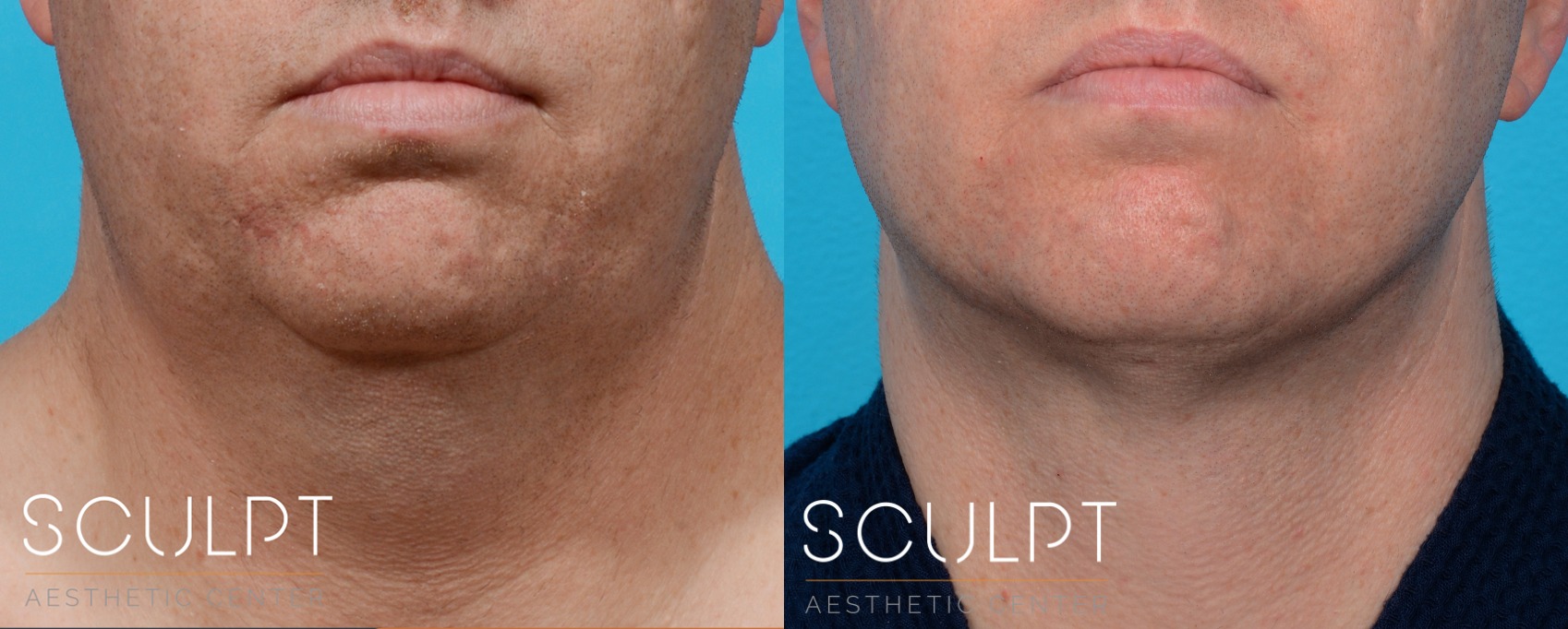 Face and Jawline Contouring Before and After Photo by Sculpt Aesthetic Center in Frisco, TX