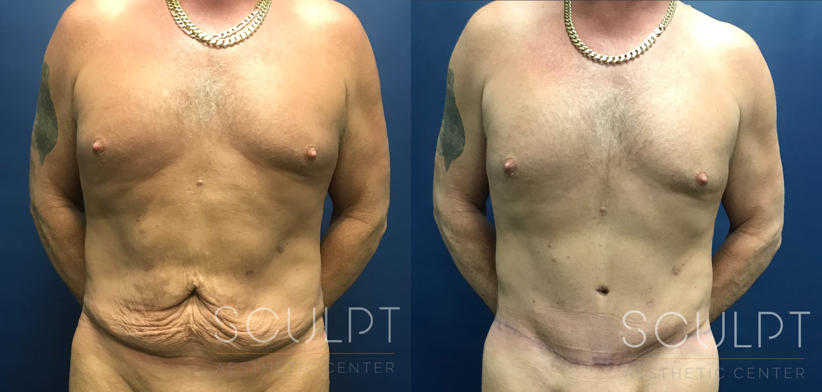 After Weight Loss Fitness Surgery Before and After Photo by Sculpt Aesthetic Center in Frisco, TX