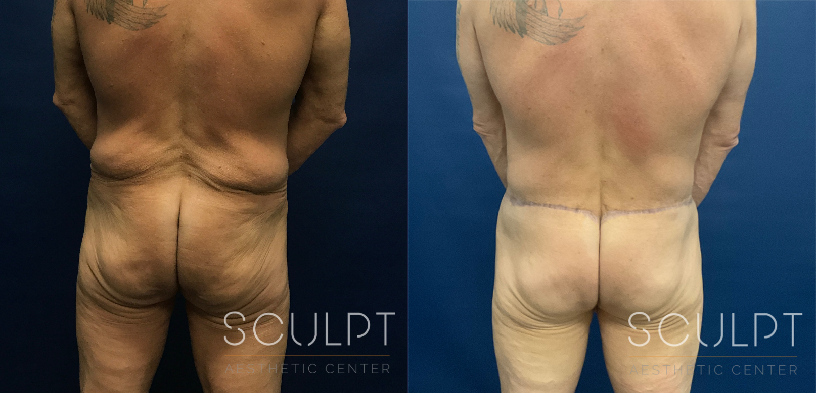 After Weight Loss Fitness Surgery Before and After Photo by Sculpt Aesthetic Center in Frisco, TX