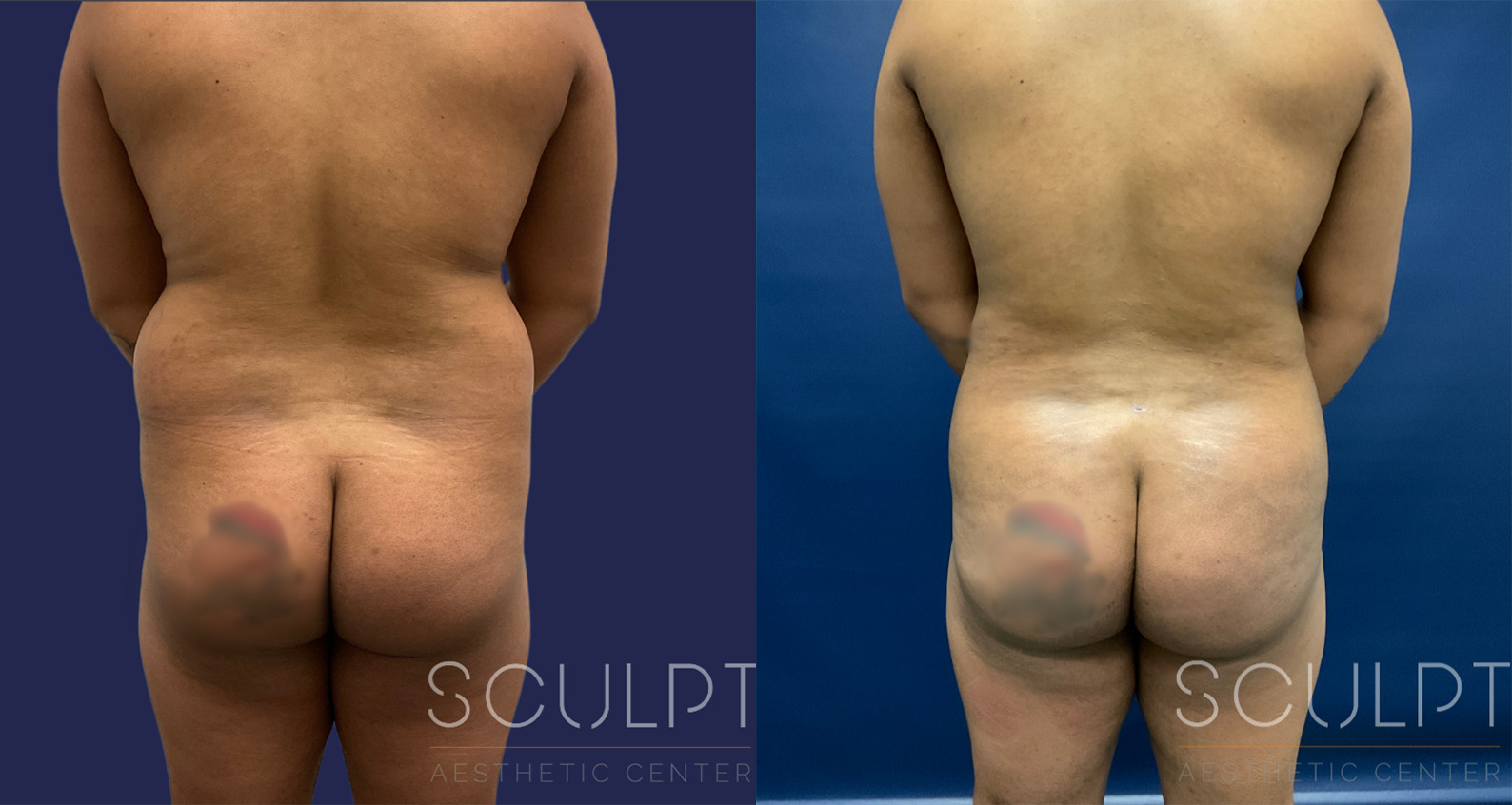 Male Gluteal (Buttock) Augmentation Before and After Photo by Sculpt Aesthetic Center in Frisco, TX