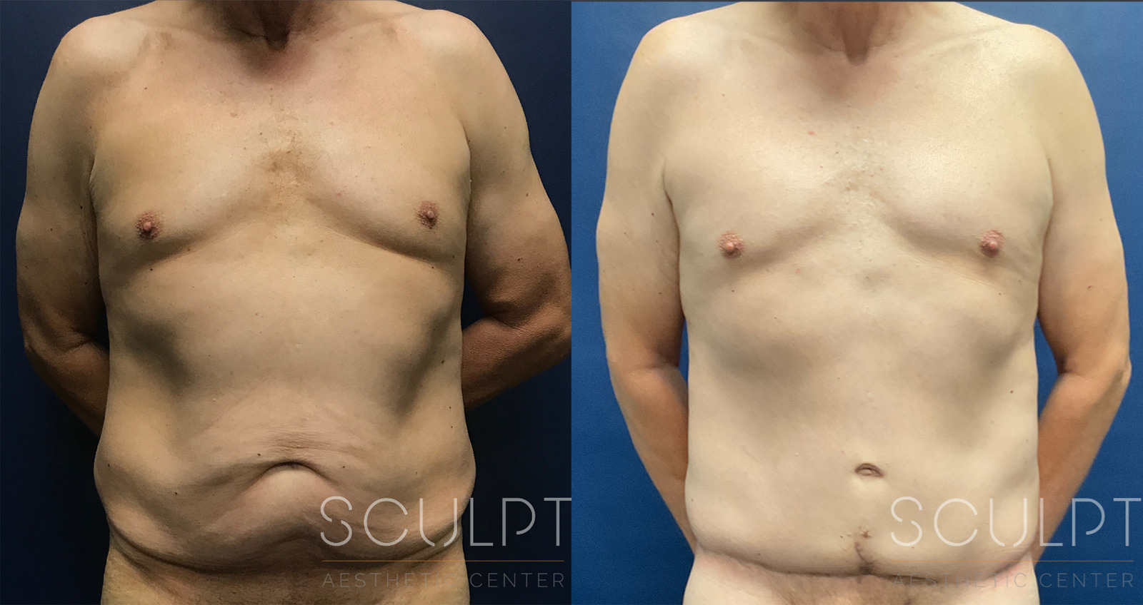 Male 360 Body Lift Before and After Photo by Sculpt Aesthetic Center in Frisco, TX