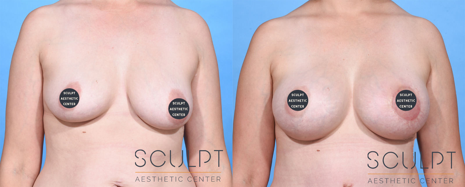 Breast Augmentation Before and After Photo by Sculpt Aesthetic Center in Frisco, TX