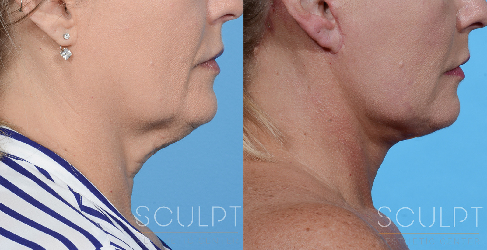 Female Neck Lift Before and After Photo by Sculpt Aesthetic Center in Frisco, TX