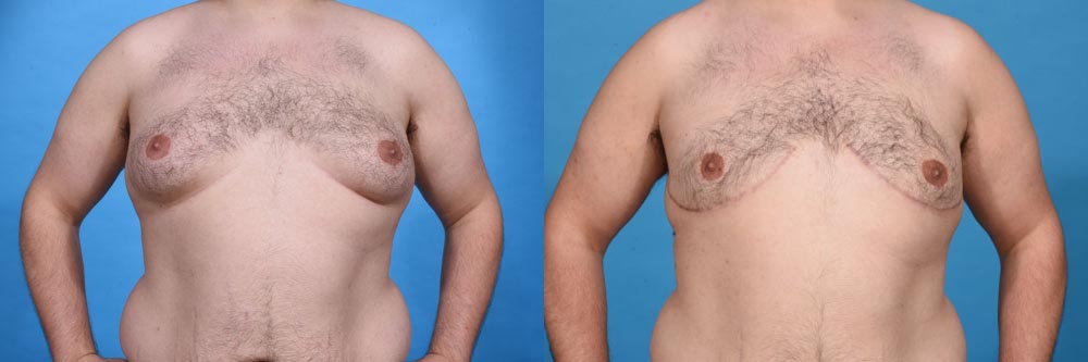 Male Breast Reduction Before and After Photo by Sculpt Aesthetic Center in Frisco, TX