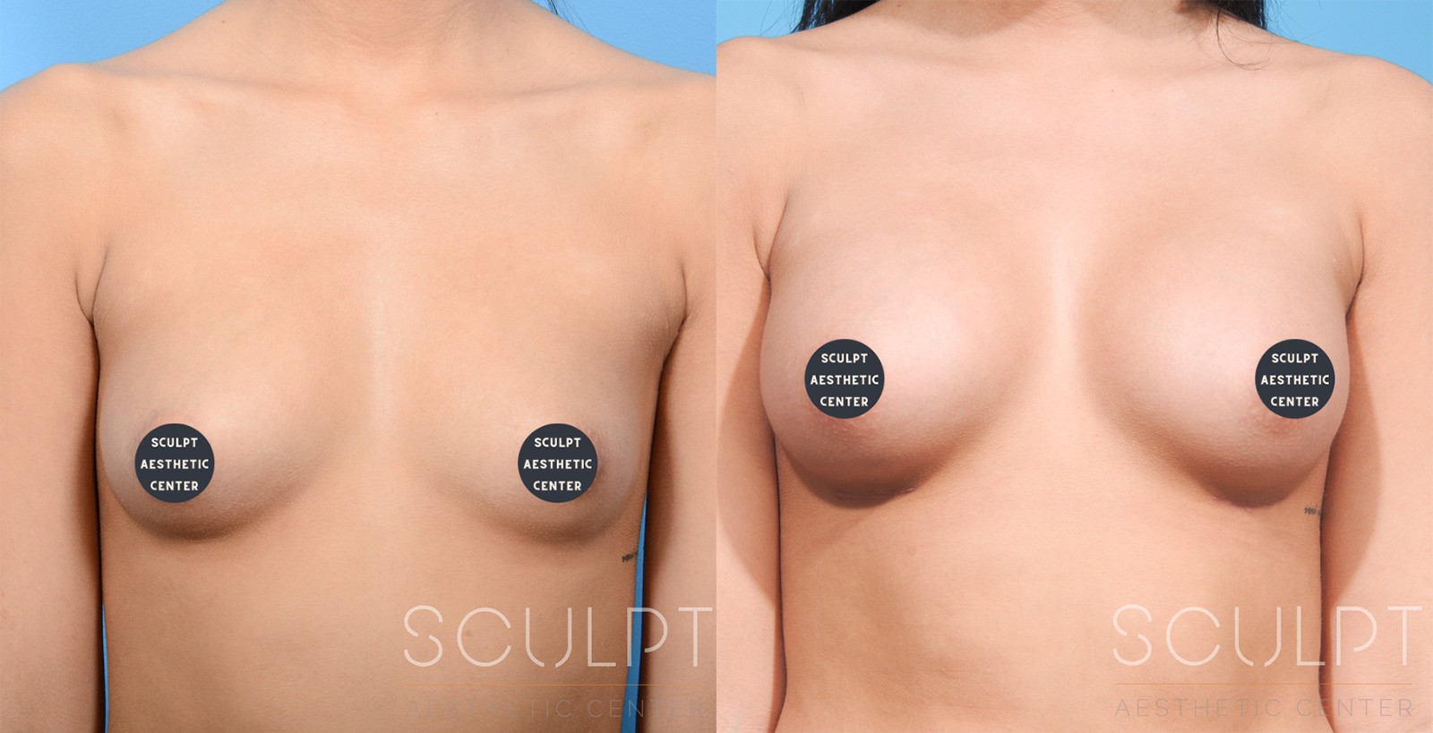 Breast Augmentation Before and After Photo by Sculpt Aesthetic Center in Frisco, TX