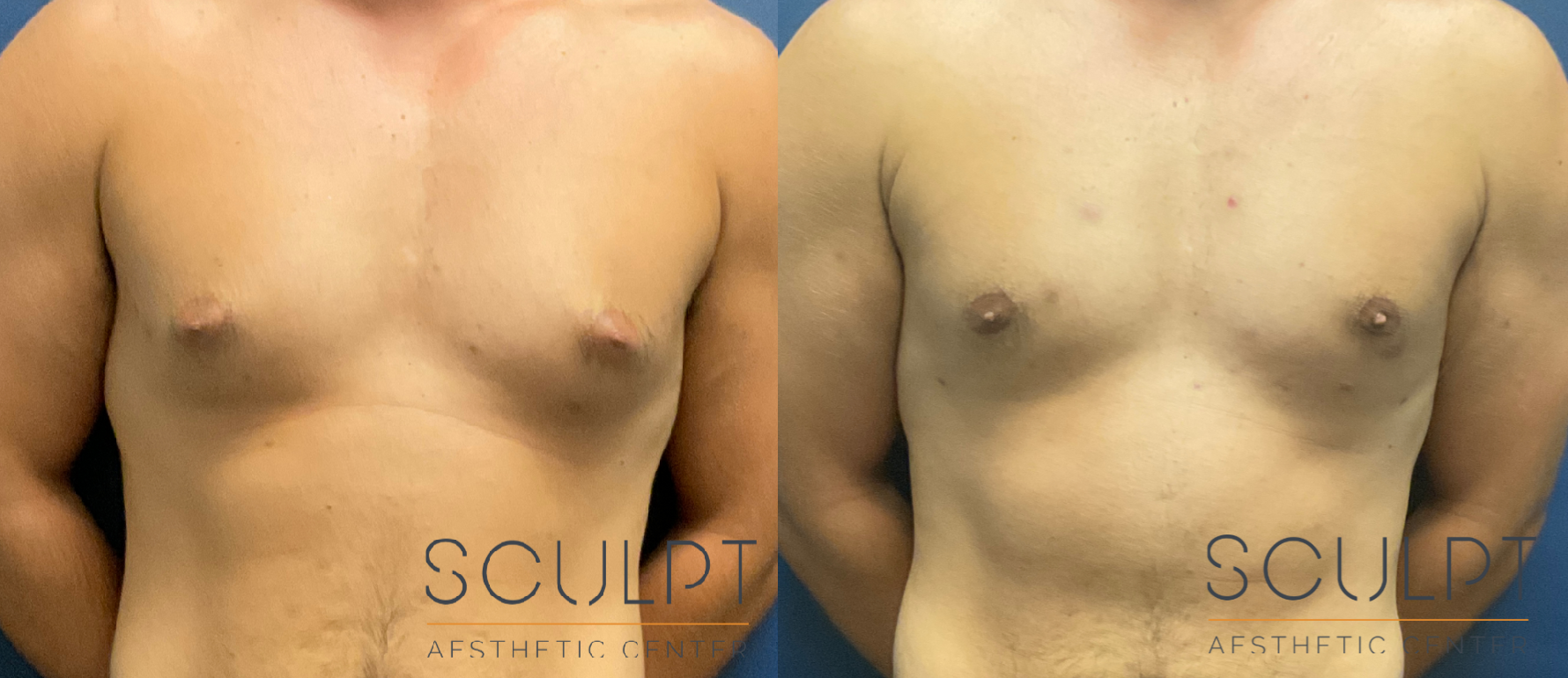 Gynecomastia Before & After Sculpcenter