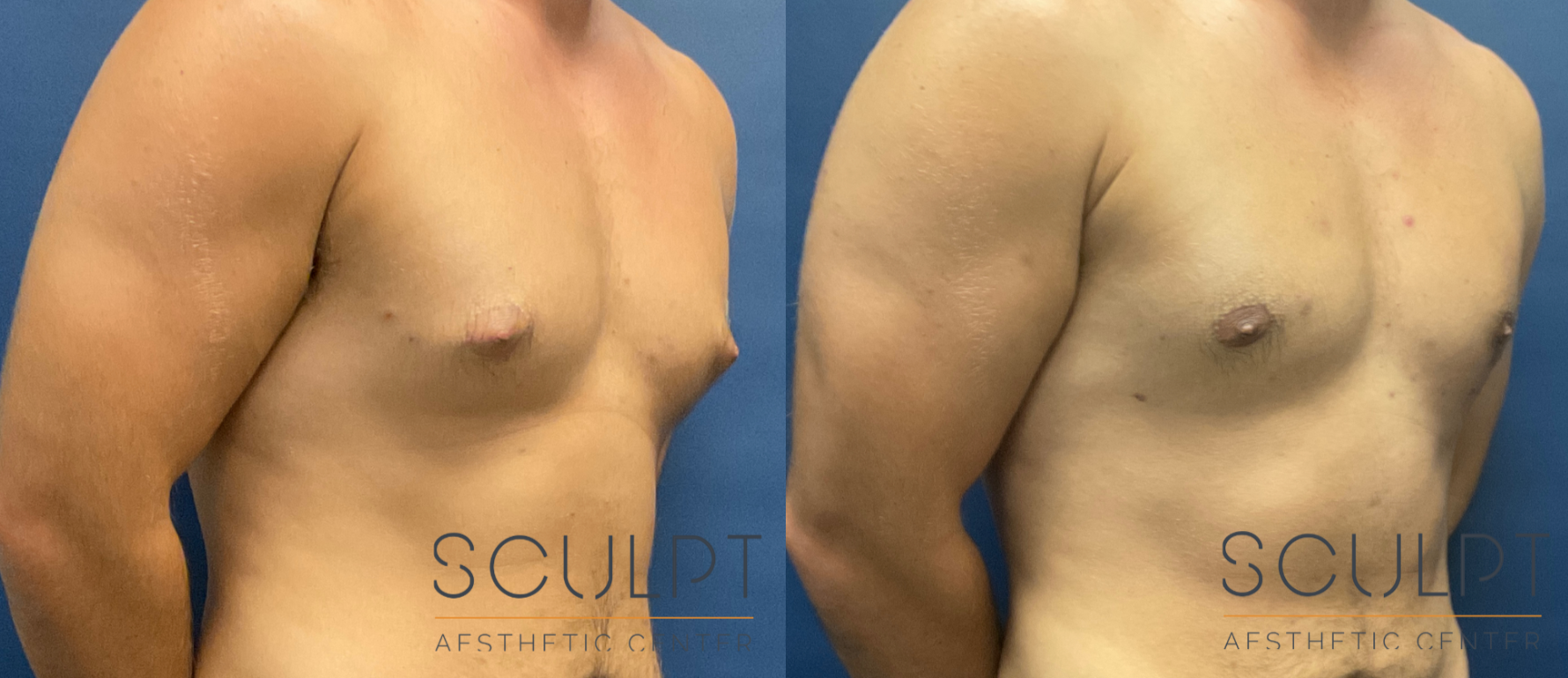 Gynecomastia Before & After Sculpcenter