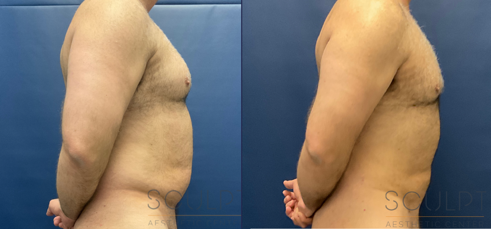 Male Liposuction Before & After Sculpcenter