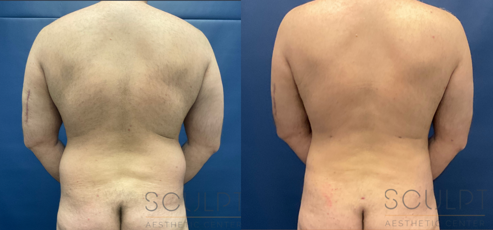 Male Liposuction Before & After Sculpcenter